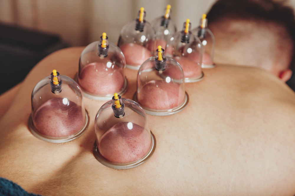 cupping